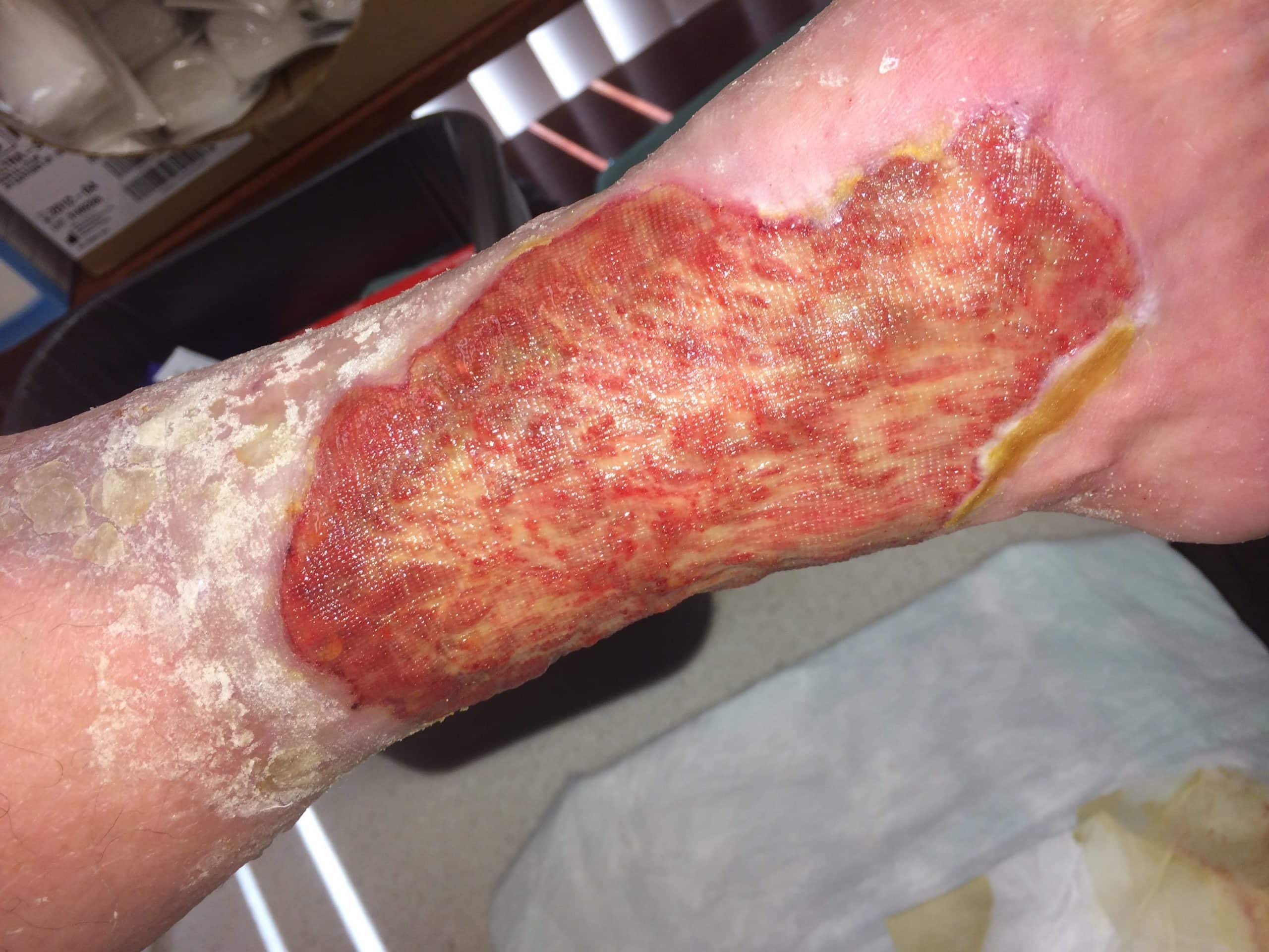 A venous leg ulcer showing early signs of healing.