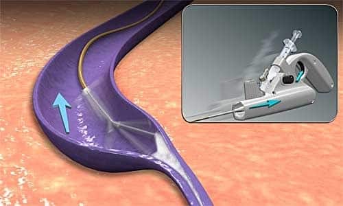 The Clarivein catheter treats varicose vein with a rotating tip.