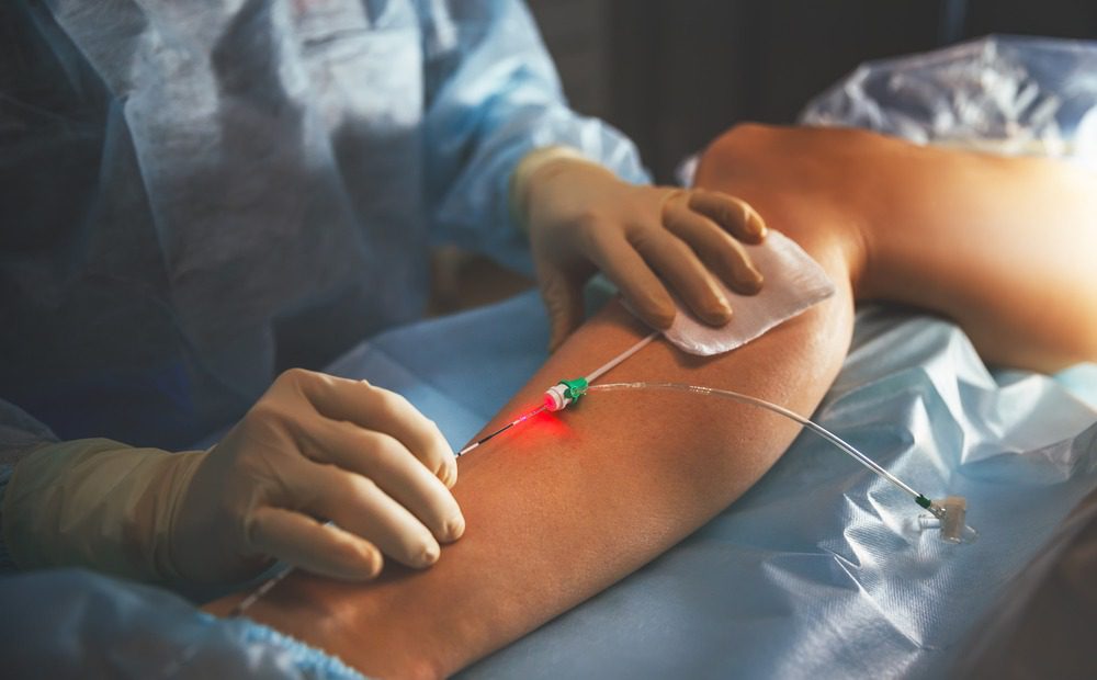 Using a laser to treat varicose veins.