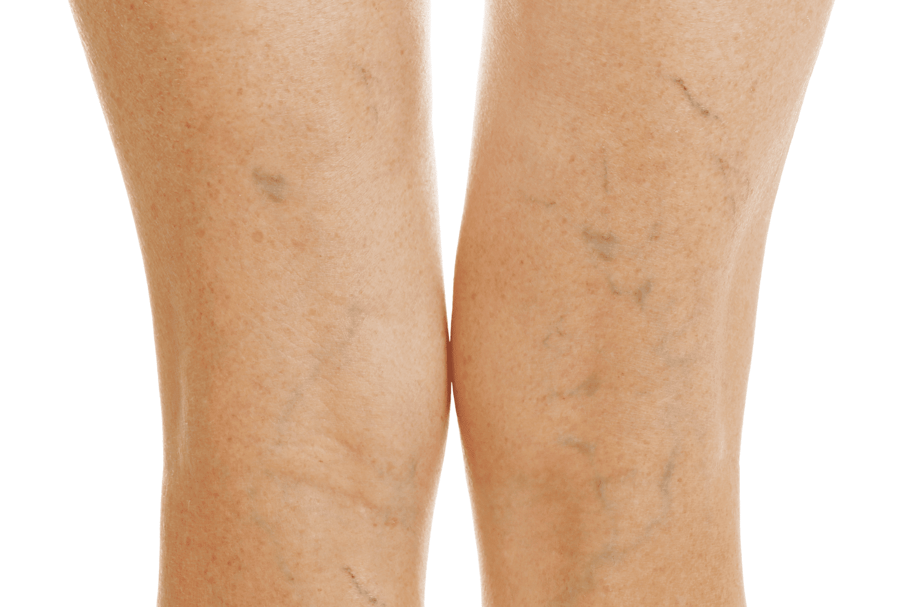 Small surface veins are often treated with sclerotherapy.