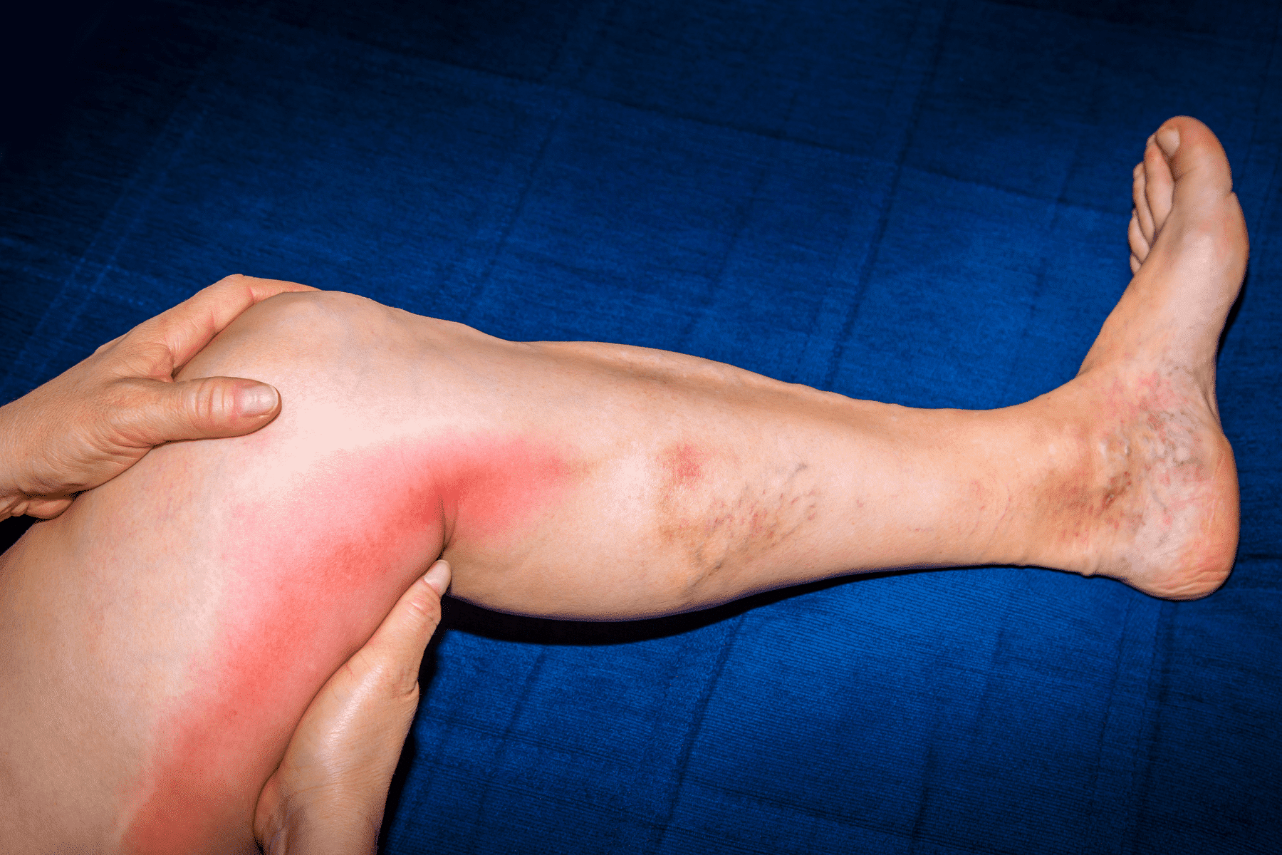 A leg with superficial thrombophlebitis and cellulitis.