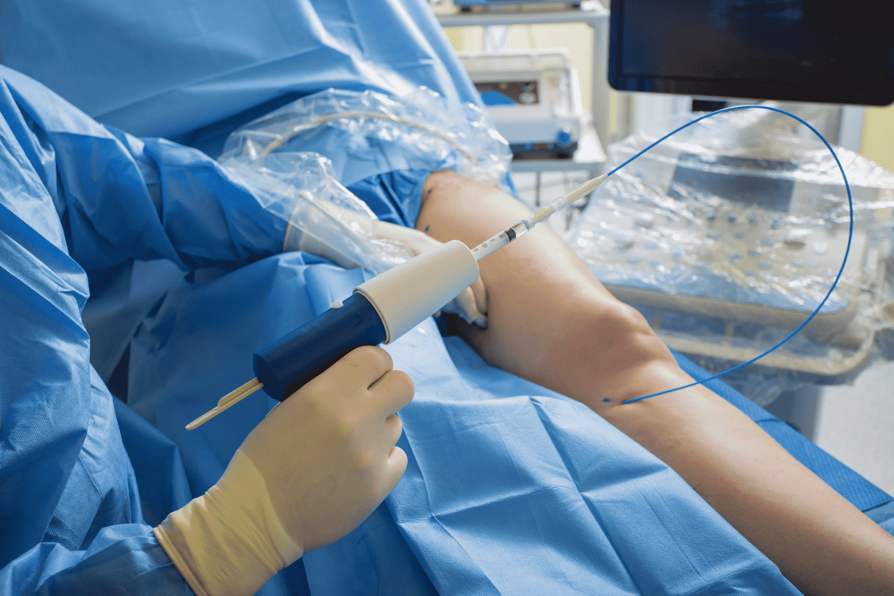 The venaseal catheter treats varicose veins using a medical glue.